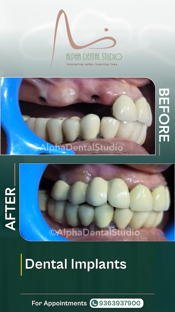 Composite veneering smile transformation before and after treatment