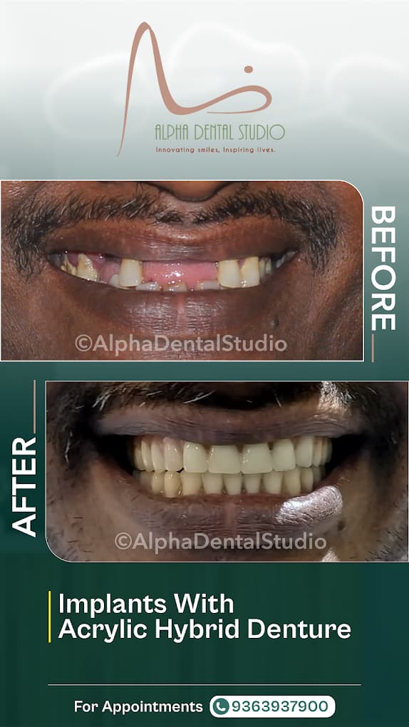 Dental smile makeover before and after treatment