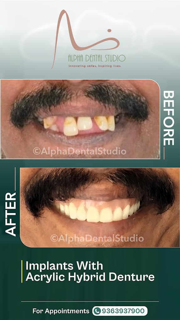 Patient dental transformation before and after treatment